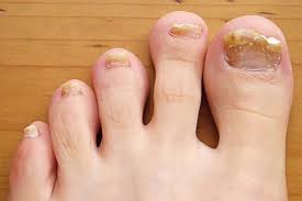 Image result for Yellow nail syndrome feet