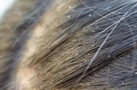 Hair dye does not kill them or prevent them from hatching. Getting Rid Of Head Lice Let S Test Your Lice Knowledge Lice Troopers Inc Licetroopers Com