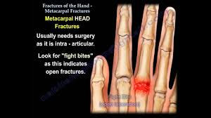 metacarpal fractures everything you