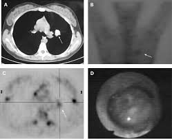 Image result for Broncholithiasis
