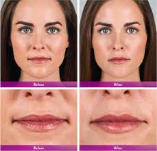How long does it take for juvederm to settle in lips. Juvederm Volbella Xc Miami Beach Laser Aesthetics