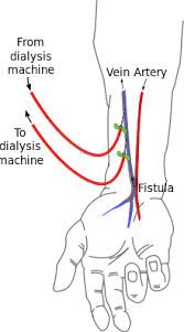Shunt Medizin Wikipedia