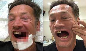 The accident happened on 17 january and owen has been stranded in thailand since, as doctors have. Eastenders Sid Owen Unveils Aftermath Of Accident Which Shattered His Jaw And Knocked Out Six Teeth Daily Mail Online