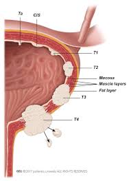 What are the symptoms of bladder cancer? Bladder Cancer Patient Information