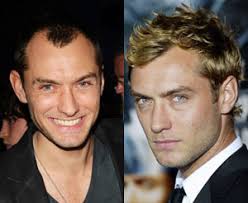 Breaking The Taboo The Impact Of Celebrity Hair Transplants Hairdr celebrity hair transplants