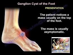 Lumps on the armpit, neck or groin. Foot And Ankle Ganglion Cyst Everything You Need To Know Dr Nabil Ebraheim Youtube