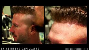 Voir plus d'idées sur le thème cheveux long homme, cheveux, cheveux long. Remplacement Capillaire Le Centre De Remplacement Capillaire De Restauration Capillaire De Greffe De Cheveux Non Chirurgicale De Transplantation De Cheveux Non Chirurgicale De Protheses Capillaires De Volumateurs Cheveux De Perruque Pour