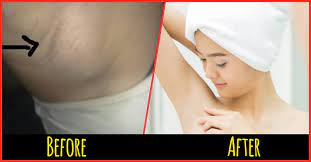 13 Home Remedies To Reduce Armpit Lumps Armpit Lump Lymph Glands Lymph Nodes Armpit
