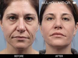 The average cost of juvederm fillers is about $600 per injection, which is slightly more expensive than botox. Juvederm Injectable Toronto See Juvederm Before Afters