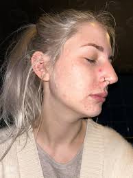 What can I do to fix my skin issue?