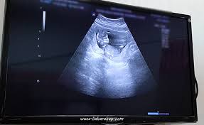 Dia memiliki rasio tubuh terhadap rasio 1: Catatan Kehamilan Selama Trimester 1 Lia Harahap