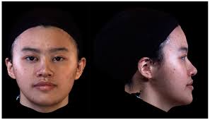 Facial Appearance and Psychosocial Features in Orthognathic Surgery: A  FACE-Q- and 3D Facial Image-Based Comparative Study of Patient-,  Clinician-, and Lay-Observer-Reported Outcomes