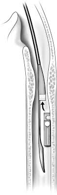 Aug 30, 2010 · other was the bravo capsule test. Upper Esophageal Ph Monitoring Transnasal Placement Of The Bravo Wireless Capsule System Sciencedirect