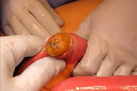 Image result for Gallstone