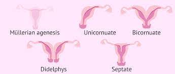 Association of renal agenesis and mullerian. Absence Of Uterus Mayer Rokitansky Kuster Hauser Syndrome