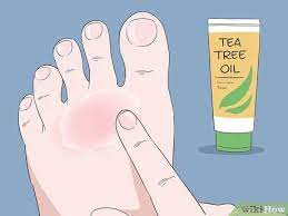 How To Cure Athlete S Foot Can Natural Remedies Help