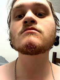 When your out of State college student calls and asks, "What is our co-pay  for the Emergency Room?".... Mitch took a puck to the face during his  hockey game tonight. Ended up