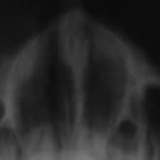 Maybe you would like to learn more about one of these? Pdf Necrotizing Sialometaplasia Of Palate With Belligerent Clinical Stance A Case Report And Review