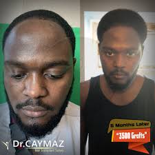 Most people have not even known or have a tiny knowledge on the treatments and techniques of this most common problem in the society. Afroamerican Hair Type Hair Transplantation Process Result