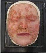 Maybe you would like to learn more about one of these? Neuer Test Erkennt Syphilis Erreger In Routineproben Und Spenderblut Healthcare In Europe Com