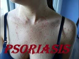 It's probably dried egg yolk or something and i don't know but i think he just puts the worms nests and stuff on the person's head. Video Scratching Psoriasis Scalp Huge Dandruff Removal With Biggest Worms On Brother Head 1120 Psoriasis News