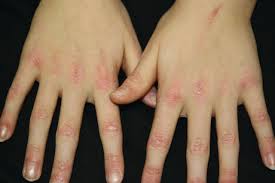 Image result for koebner phenomenon psoriasis