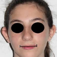 Measurement of the length of the lips.