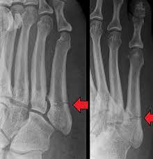 Jones Fracture - Wikipedia