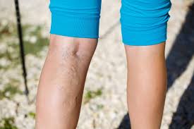 Varicose veins on a leg. Everything You Need To Know About Varicose Veins Rai Health Awareness Blog