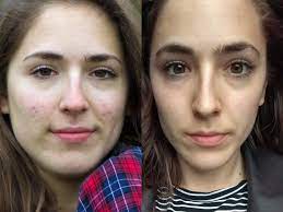 I can promise anybody suffering. What It S Like To Take Accutane The Drug That Can Permanently Cure Acne