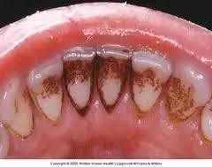 How to get rid of and prevent yellow underarm stains. How To Remove Stains From Braces On Your Teeth Quora