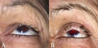 Image result for Entropion