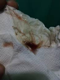 Sangrado De Implantacion Confirmado Primeros Sintomas Babycenter