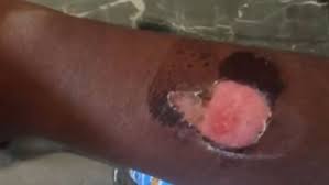 Maybe you would like to learn more about one of these? Warnings Over Salt And Ice Challenge Internet Craze Itv News