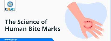 Image result for Human Bite