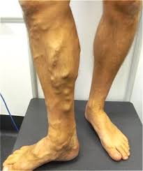 Varicose veins are swollen, twisted veins that can be seen just under the surface of the skin. Minimally Invasive Varicose Vein Treatments
