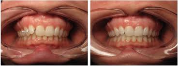 The inman aligner is the perfect solution for crowding or protrusion of the front teeth. Inman Aligner Traders Point Dental