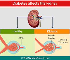 Renal diseases that are unrelated to diabetes (7,8)(figure 1). Diabetes And Renal Failure Everything You Need To Know