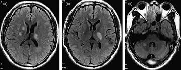 Image result for Neurosyphilis