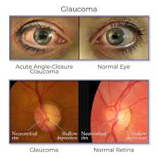Image result for Glaucoma