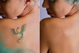 How does laser tattoo removal work? Laser Tattoo Removal Services Removery
