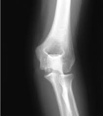 For displaced medial condyle fractures in children, open reduction with internal fixation seems to be most popular treatment method. Https Posna Org Physician Education Study Guide Humerus Medial Epicondyle Fractures