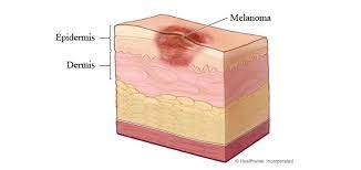 Frederick mohs at the university of wisconsin and is now practiced throughout the world. Mohs Micrographic Surgery For Skin Cancer