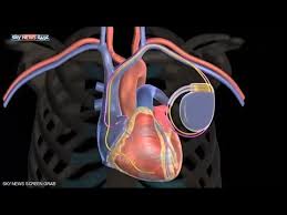 Context sentences for pacemaker in arabic. ØªØ·ÙˆÙŠØ± Ø£ØµØºØ± Ù…Ù†Ø¸Ù… Ø¶Ø±Ø¨Ø§Øª Ù„Ù„Ù‚Ù„Ø¨ Youtube
