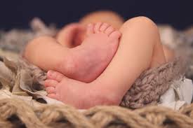 Image result for Clubfoot