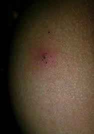 I Was Wondering Why My Butt Cheek Was Hurting So I Went To The Bathroom To See What It Was And I Took This Should I Be Concerned Glow Community