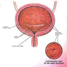 Interstitial Cystitis Nyc Pelvic Pain Doctor Dr Mariz Midtown Nyc