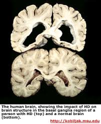 Too Fast Too Furious Huntington S Disease Huntington Disease Huntington Chorea Disease Symptoms