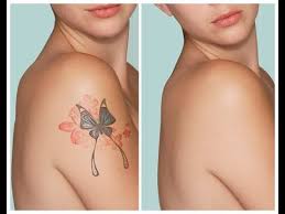 We believe in helping you find the product that looking for something more? Can Tattoos Be Removed Completely Laser Tattoo Removal Youtube