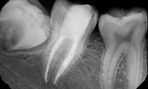 Precautions for carious teeth during root canal | dr sai harish | telugu health | doctor plus tv. Oak Tree Dentistry S Smile Gallery Root Canal Treatment